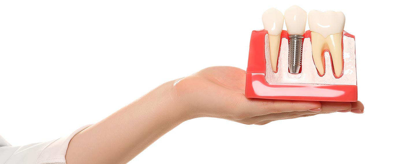 manavgat dental implants